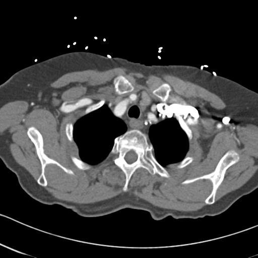 Aortic intramural hematoma from penetrating atherosclerotic ulcer (Radiopaedia 31137-31836 A 9).jpg