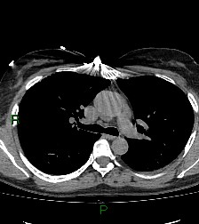 Aortic valve endocarditis (Radiopaedia 87209-103485 Axial non-contrast 42).jpg