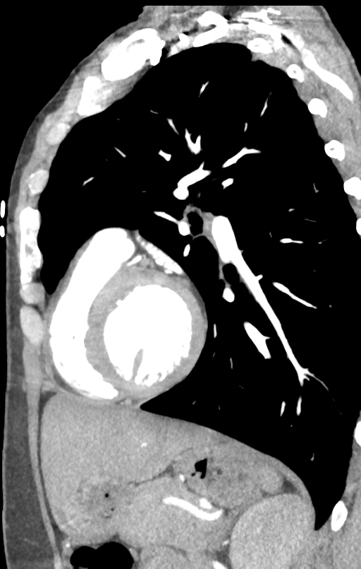 Aortic valve non-coronary cusp thrombus (Radiopaedia 55661-62189 C+ arterial phase 17).png