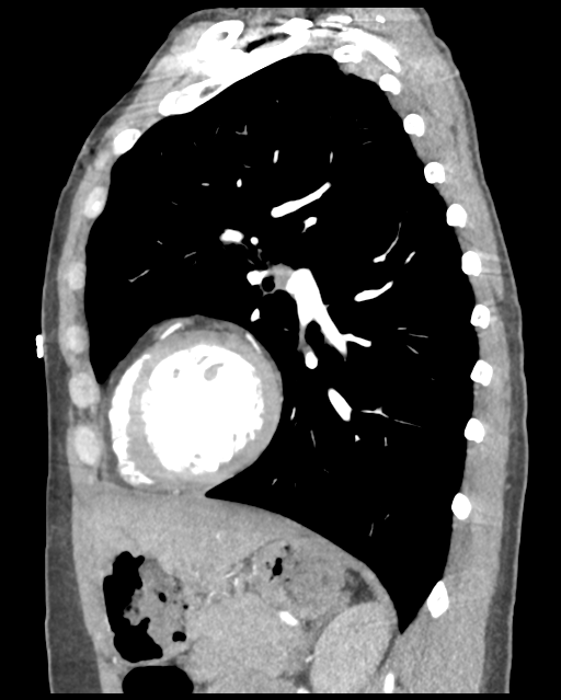 Aortic valve non-coronary cusp thrombus (Radiopaedia 55661-62189 D 20).png