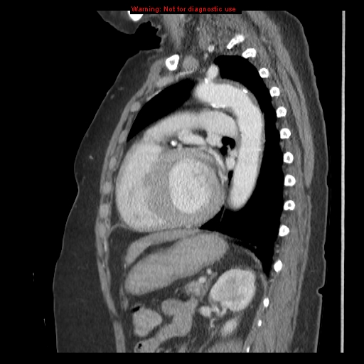 File:Aortic valve stenosis (Radiopaedia 14480-14423 B 11).jpg