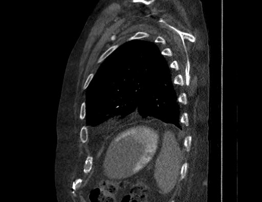 Aortoesophageal fistula with endovascular repair (Radiopaedia 73781-84592 Sagittal C+ CTPA 167).jpg