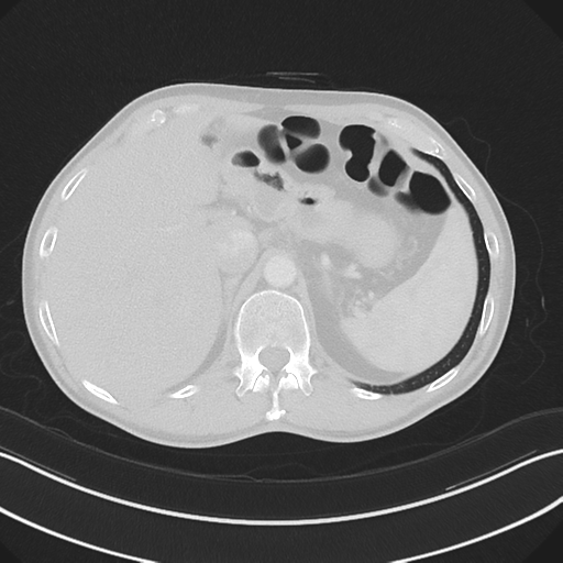 Apical pleural calcification (Radiopaedia 46141-50499 Axial lung window 69).png