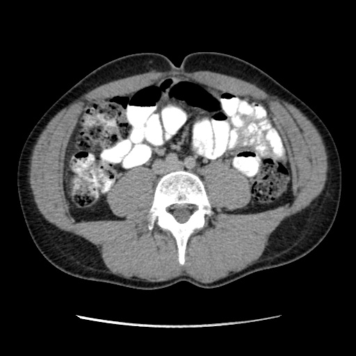 File:Appendicitis complicated by post-operative collection (Radiopaedia 35595-37113 A 43).jpg
