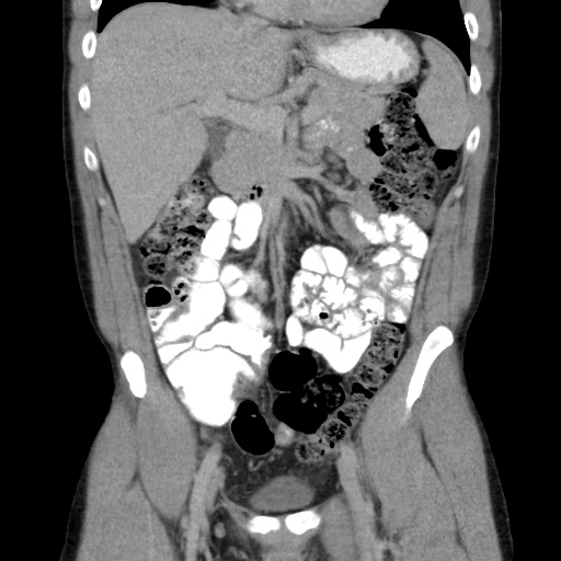 File:Appendicitis complicated by post-operative collection (Radiopaedia 35595-37113 B 23).jpg