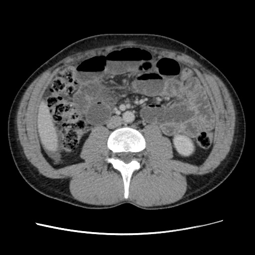 File:Appendicitis complicated by post-operative collection (Radiopaedia 35595-37114 A 44).jpg
