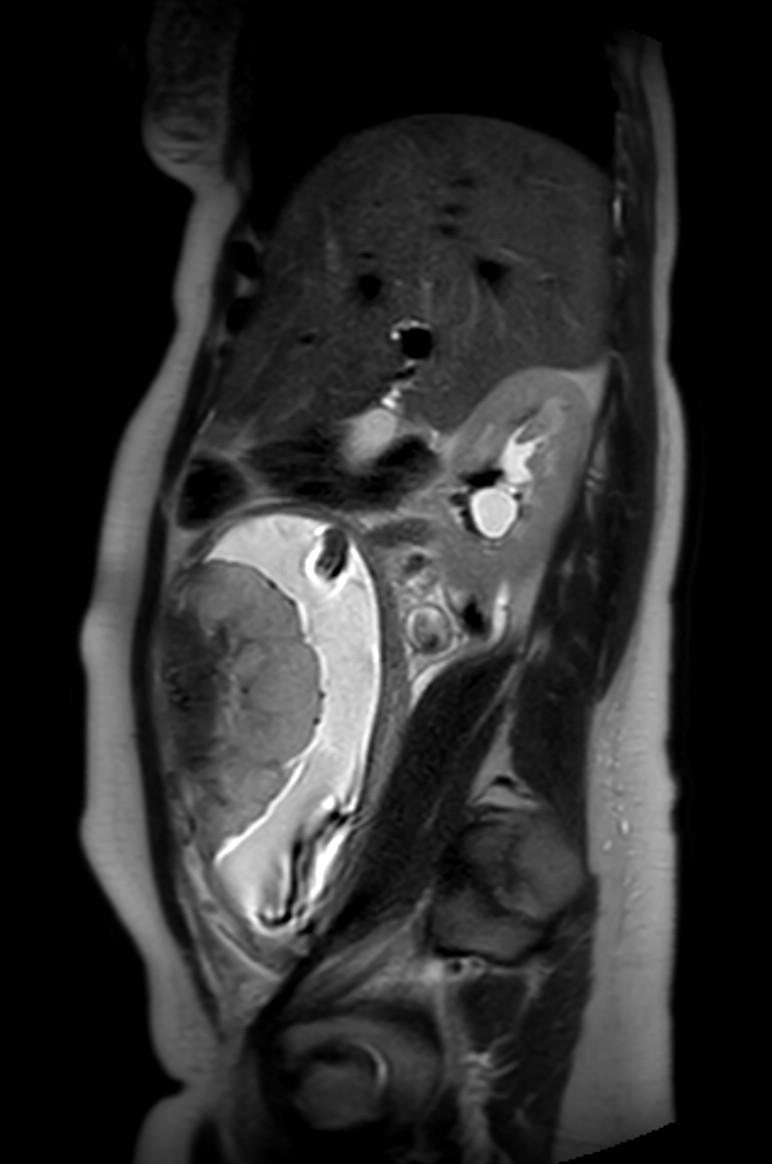 Appendicitis in gravida (MRI) (Radiopaedia 89433-106395 Sagittal T2 44).jpg
