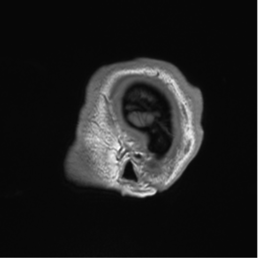 File:Arachnoid cyst with subdural hematoma (Radiopaedia 85892-101743 Sagittal T1 87).png