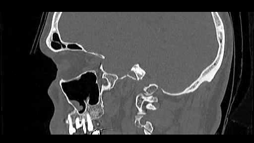 Arcuate foramen (Radiopaedia 89833-106944 Sagittal bone window 17).jpg