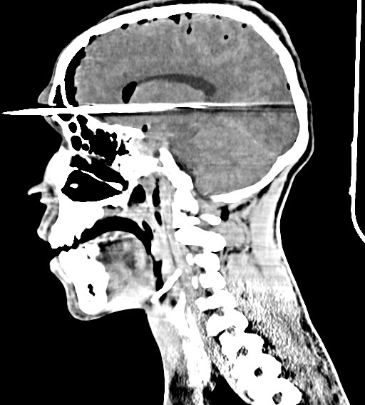 Arrow injury to the brain (Radiopaedia 72101-82607 H 38).jpg