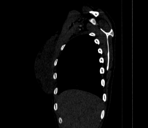 Arteria lusoria (Radiopaedia 88528-105192 C 21).jpg