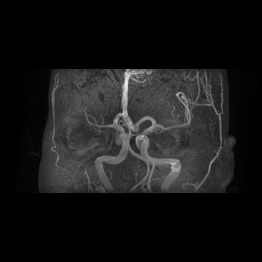Arteriovenous malformation (Radiopaedia 71628-81999 Axial MRA 10).jpg