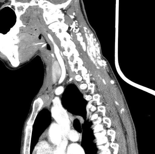 Arteriovenous malformation of the neck (Radiopaedia 53935-60062 C 51).jpg
