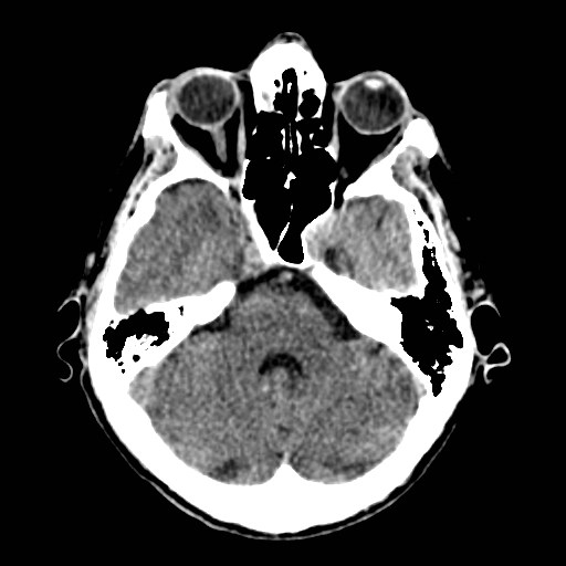 File:Artery of Percheron infarct (Radiopaedia 48088-52893 Axial non-contrast 10).jpg