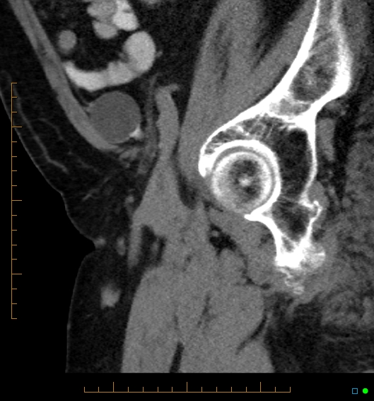 File:Artificial urethral sphincter (Radiopaedia 46937-51464 Sagittal C+ delayed 6).jpg