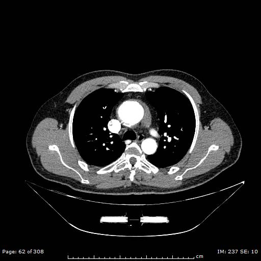 Ascending aortic aneurysm (Radiopaedia 50086-55404 A 17).jpg