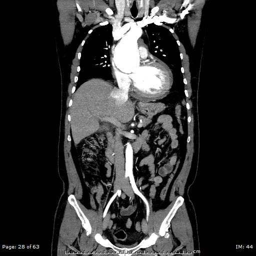Ascending aortic aneurysm (Radiopaedia 50086-55404 B 28).jpg