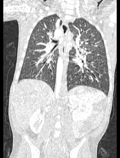 Asplenia syndrome (Radiopaedia 73083-83792 Coronal lung window 90).jpg