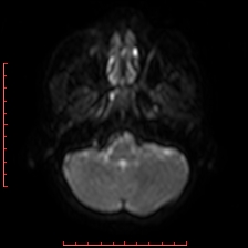 Astroblastoma (Radiopaedia 74287-85162 Axial DWI 11).jpg