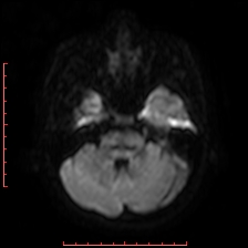 Astroblastoma (Radiopaedia 74287-85162 Axial DWI 22).jpg