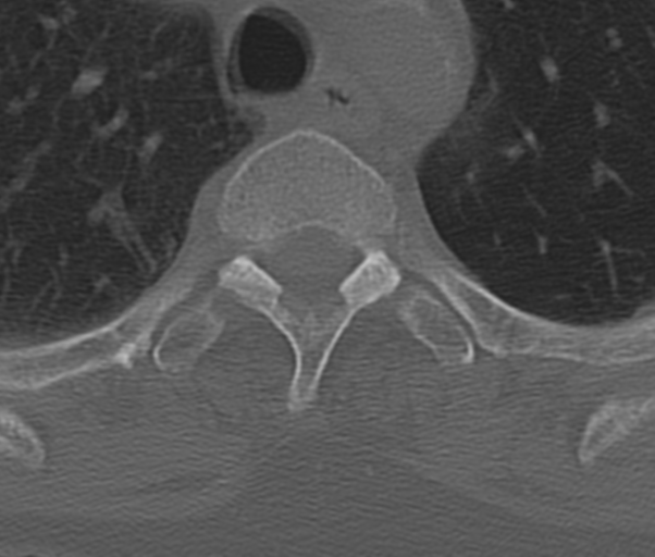 Atlanto-axial subluxation (Radiopaedia 36610-38176 Axial bone window 59).png