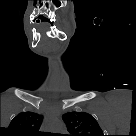 Atlanto-occipital dissociation (Traynelis type 1), C2 teardrop fracture, C6-7 facet joint dislocation (Radiopaedia 87655-104061 Coronal bone window 11).jpg