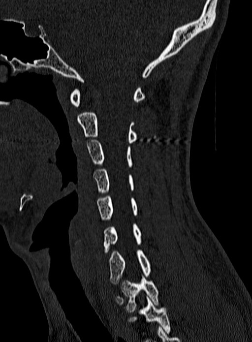 Atlantoaxial subluxation (Radiopaedia 44681-48450 Sagittal bone window 48).jpg
