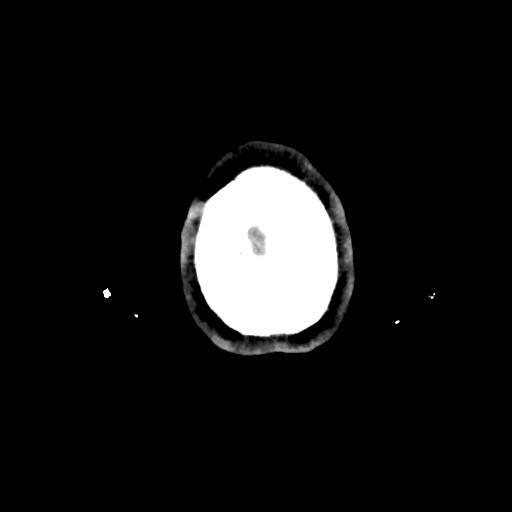 Atretic cephalocele (Radiopaedia 89782-106881 Axial non-contrast 184).jpg