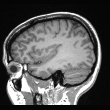 Atretic encephalocoele with inferior vermis hypoplasia (Radiopaedia 30443-31108 Sagittal T1 31).jpg
