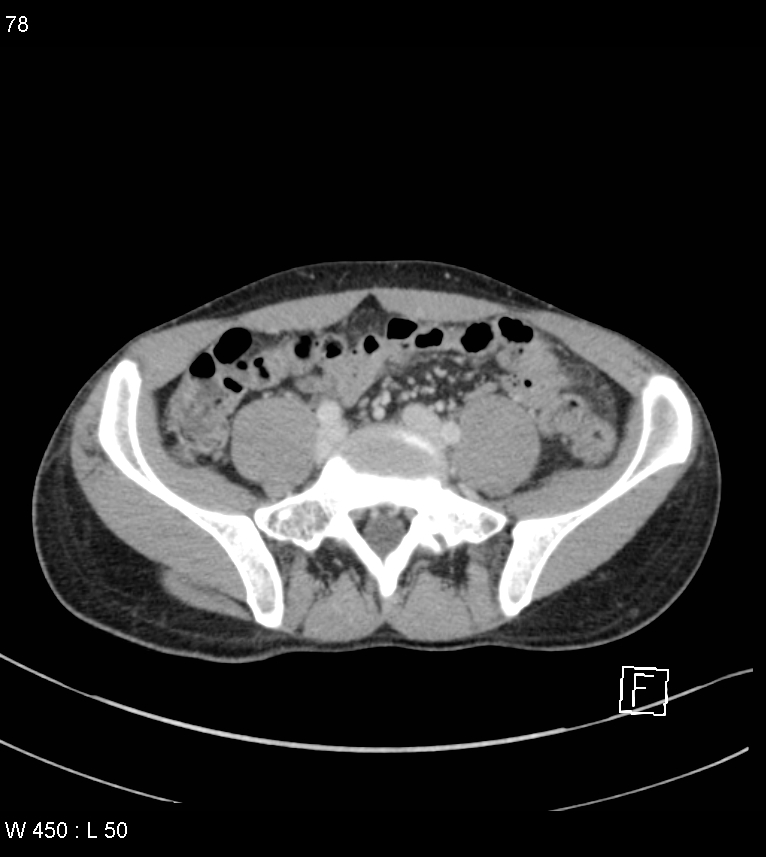 Atypical acute epiploic appendagitis (Radiopaedia 55479-61943 A 77).jpg