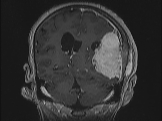 File:Atypical meningioma (Radiopaedia 62985-71406 Coronal T1 C+ 78).jpg