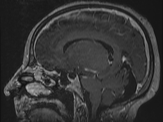 Atypical meningioma (Radiopaedia 62985-71406 Sagittal T1 C+ 49).jpg