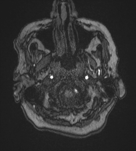 Atypical meningioma (WHO Grade II) (Radiopaedia 54742-60981 Axial MRA 7).png