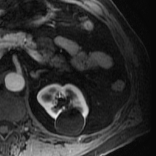 File:Atypical renal cyst on MRI (Radiopaedia 17349-17046 C 10).jpg