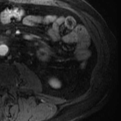 File:Atypical renal cyst on MRI (Radiopaedia 17349-17046 C 30).jpg