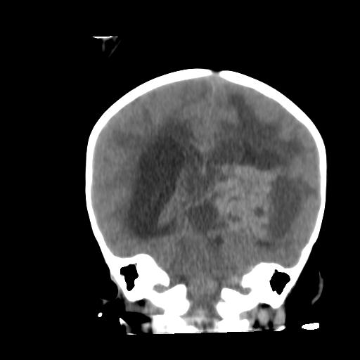 Atypical teratoid rhabdoid tumor (AT-RT) (Radiopaedia 85823-101654 Coronal non-contrast 33).jpg