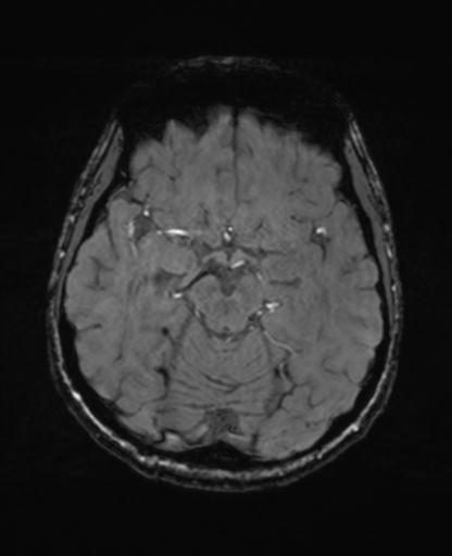Autoimmune limbic encephalitis (Radiopaedia 30363-31005 SWI - magnitude 30).jpg