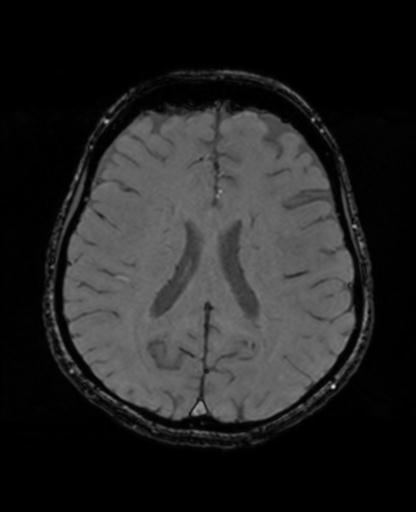 File:Autoimmune limbic encephalitis (Radiopaedia 30363-31005 SWI - magnitude 49).jpg