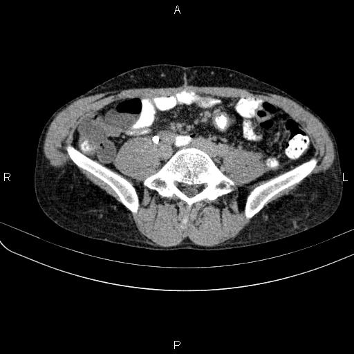 File:Autoimmune pancreatitis (Radiopaedia 84925-100431 Axial C+ delayed 58).jpg