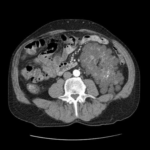 Autosomal dominant polycystic kidney disease (Radiopaedia 27851-28094 B 81).jpg