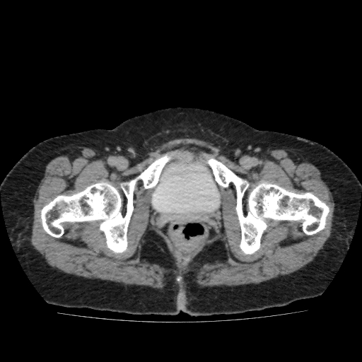 Autosomal dominant polycystic kidney disease (Radiopaedia 38189-40194 Axial C+ delayed 59).jpg