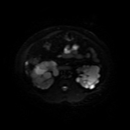 Autosomal dominant polycystic kidney disease (Radiopaedia 50259-55611 Axial DWI 24).jpg
