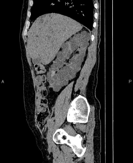 Autosomal dominant polycystic kidney disease (Radiopaedia 87830-104287 C 25).jpg