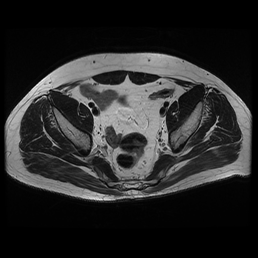 File:Avascular necrosis of the hip (Radiopaedia 61503-69465 T2 9).jpg