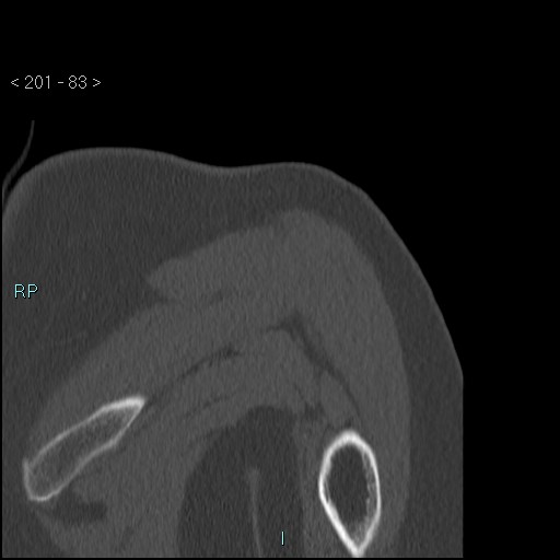 Avascular necrosis of the shoulder - Cruess stage I (Radiopaedia 77674-89887 Coronal bone window 82).jpg