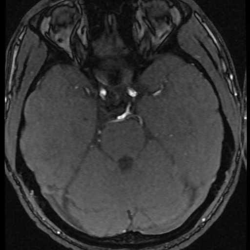 Azygos anterior cerebral artery (Radiopaedia 17059-16756 Axial MRA 51).jpg
