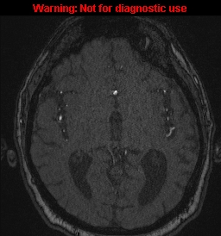Azygos anterior cerebral artery (Radiopaedia 59325-66677 Axial MRA 82).jpg