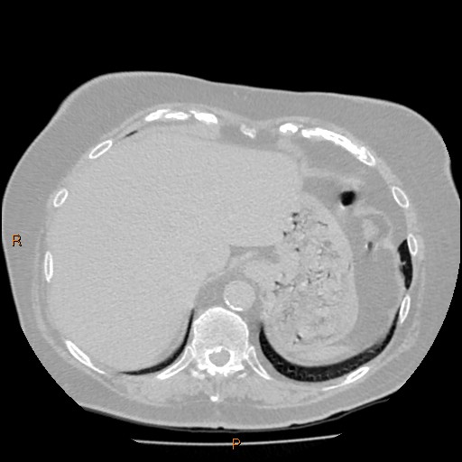 Azygos lobe (Radiopaedia 40161-42821 Axial lung window 64).jpg