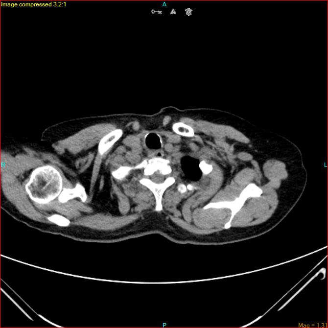 Azygos vein aneurysm (Radiopaedia 77824-90130 A 7).jpg