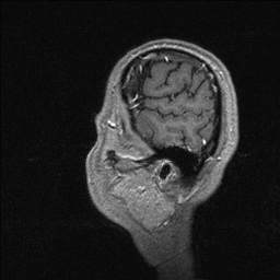 Balo concentric sclerosis (Radiopaedia 50458-55940 Sagittal T1 C+ 22).jpg